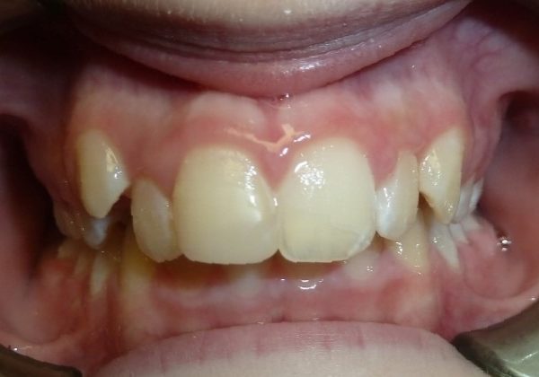 patient before braces