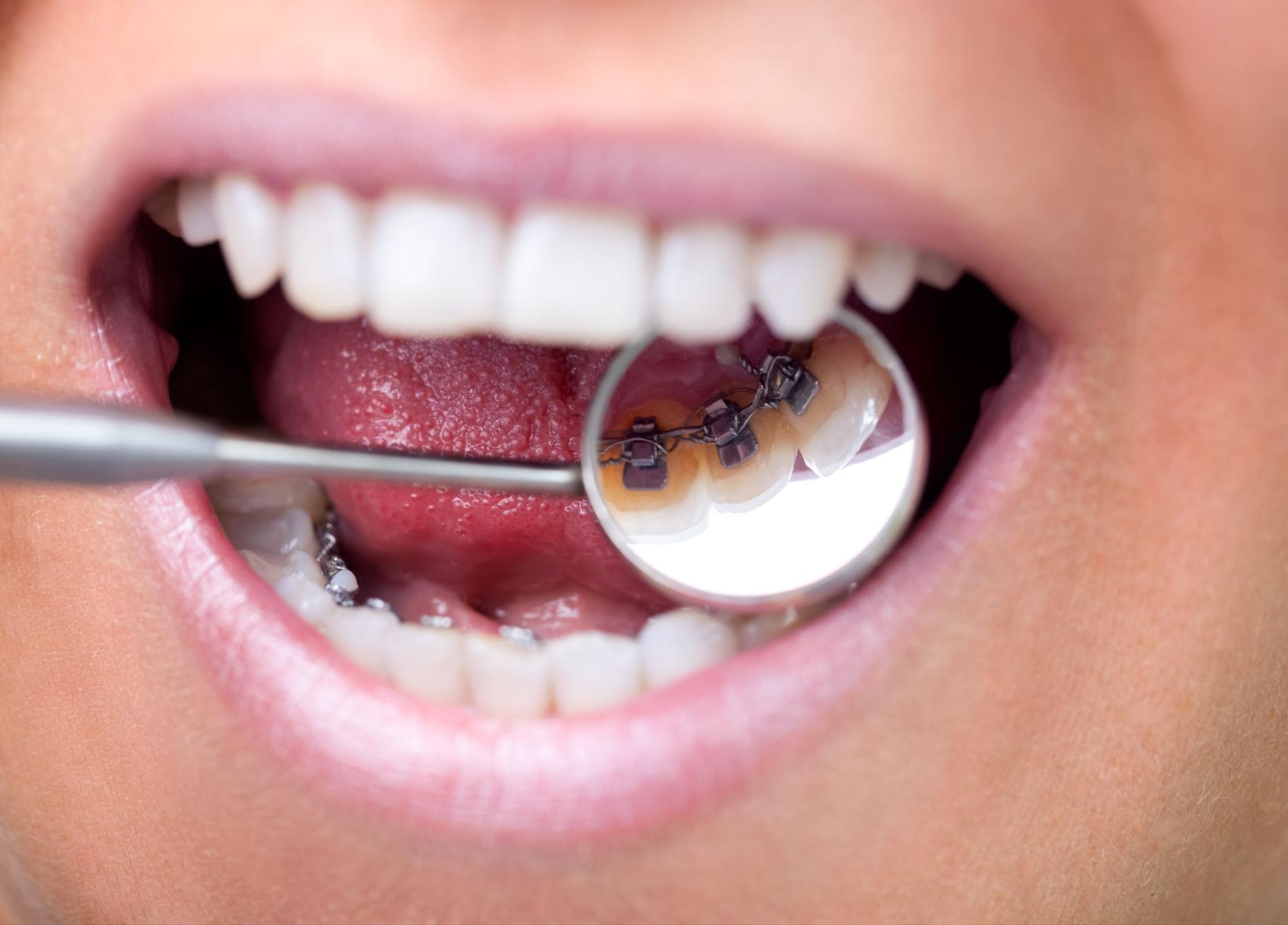 Everything You Need to Know About Lingual Braces